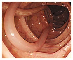 Ascariasis