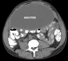 Ascites