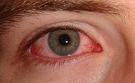Bloed in het oog