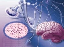 Epilepsie