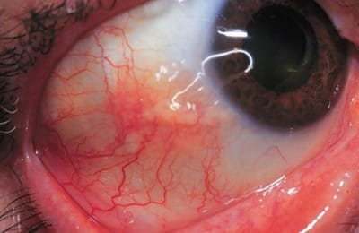 Episcleritis