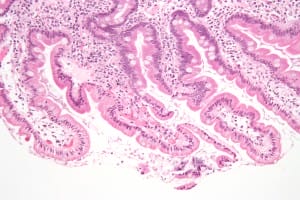 Giardiasis