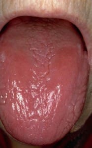Glossitis