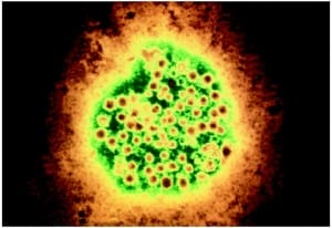 Hepatitis D