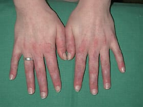 Lupus erythematodes