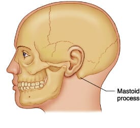 Mastoiditis