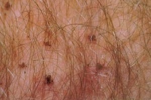 Pediculose