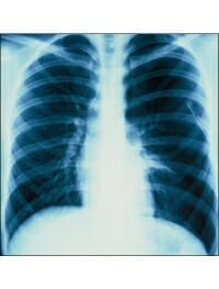 Pneumothorax