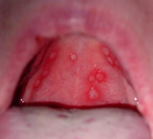Stomatitis