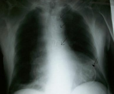 Ventriculair aneurysma-ruptuur