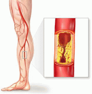 claudicatio intermittens