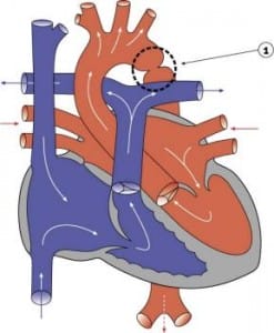 coarctatio aortae