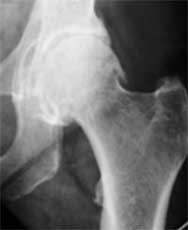 coxarthrosis