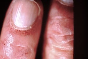 dermatomyositis