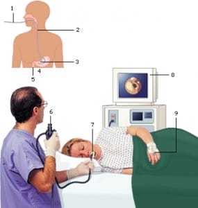 endoscopie van de slokdarm