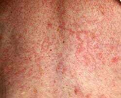 erythema exsudativum multiforme