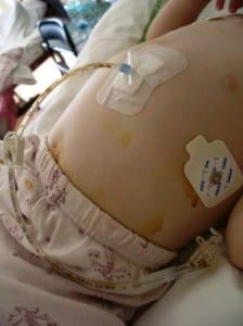 gastrostomie
