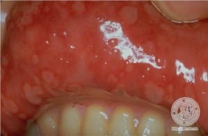 gingivostomatitis