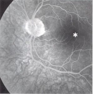 hersenangiografie