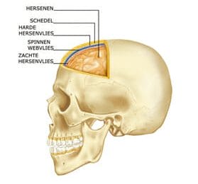 hersenvliesgezwel