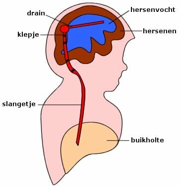 hersenvocht