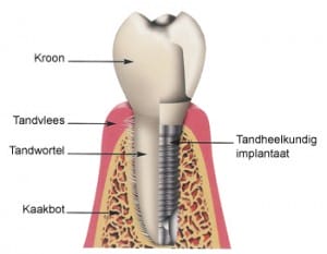 implantatie van tanden