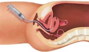 intra-uterine contraceptie
