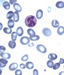 pernicieuze anemie