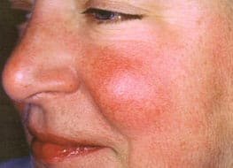 rosacea