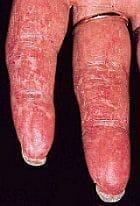 sclerodermie