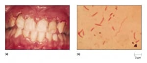 stomatitis van plaut-vincent