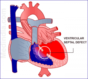 ventrikel septum defect