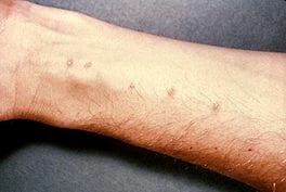 Bilharzia
