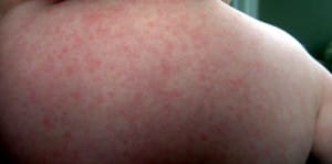 Roseola