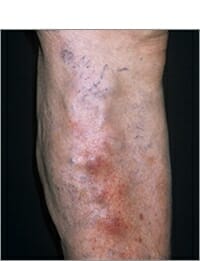 Tromboflebitis