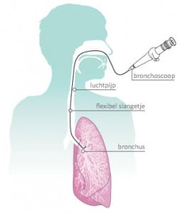 bronchoscopie