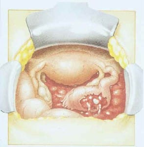 Buitenbaarmoederlijke zwangerschap Voortplanting | Menselijk Lichaam