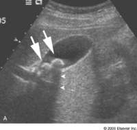 cholelithiasis