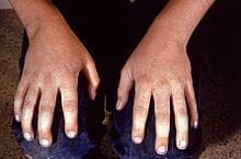 erytheem