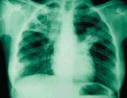 longtuberculose