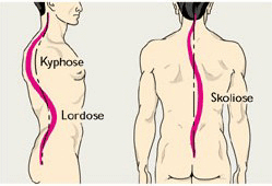 lordose