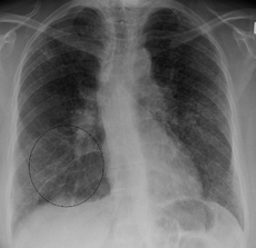 sarcoidosis
