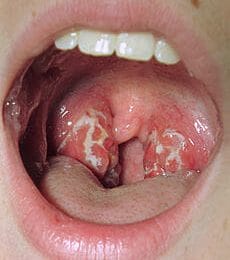 tonsillitis