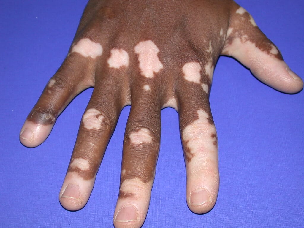 vitiligo