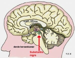 Ziekte Van Parkinson | Hersenen | Menselijk Lichaam
